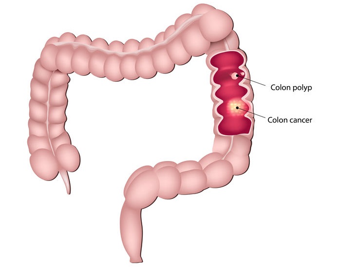 Colon cancer and colon polyps