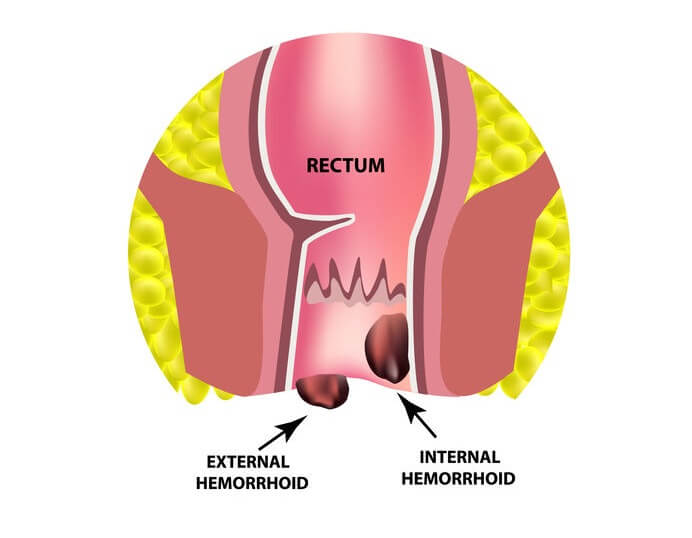 rectal cancer vs hemorrhoid
