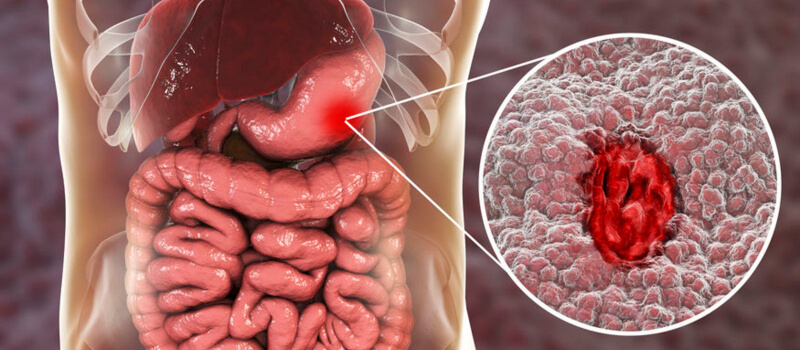 peptic ulcer 3d illustration