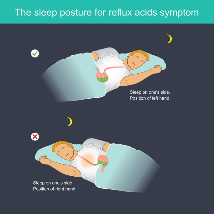 what-is-the-best-sleeping-position-if-i-have-acid-reflux